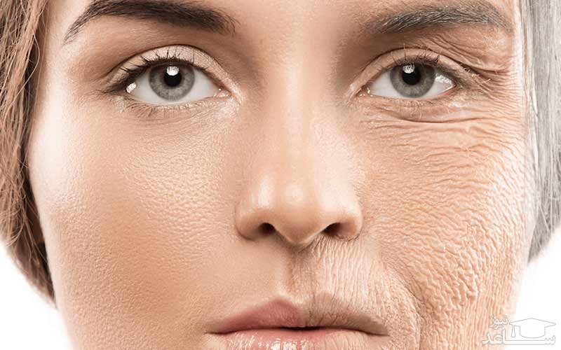 کلاژن سازی پوست