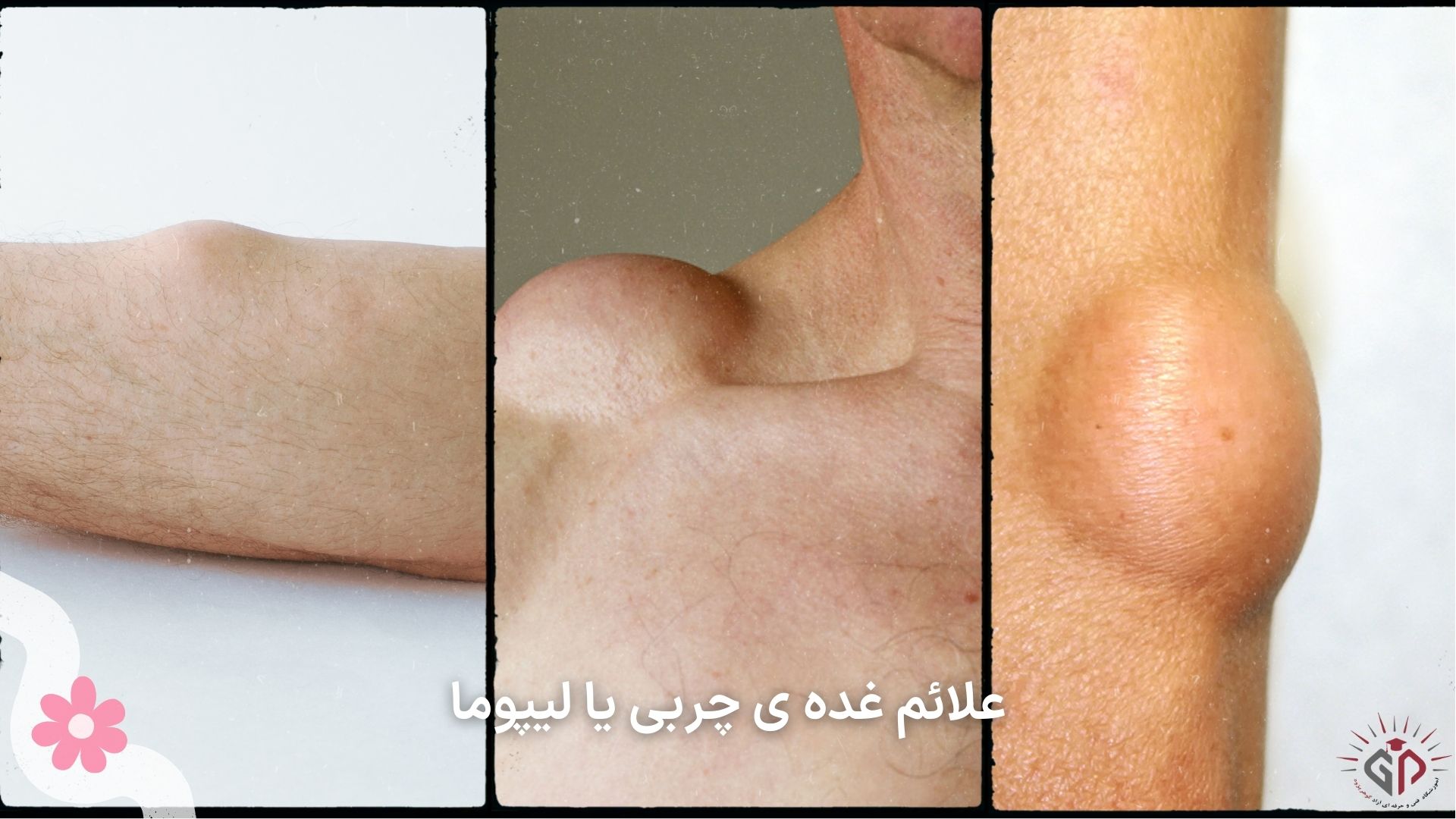 علائم غده ی چربی یا لیپوما
