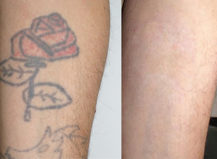 پاک کردن تاتو با لیزر