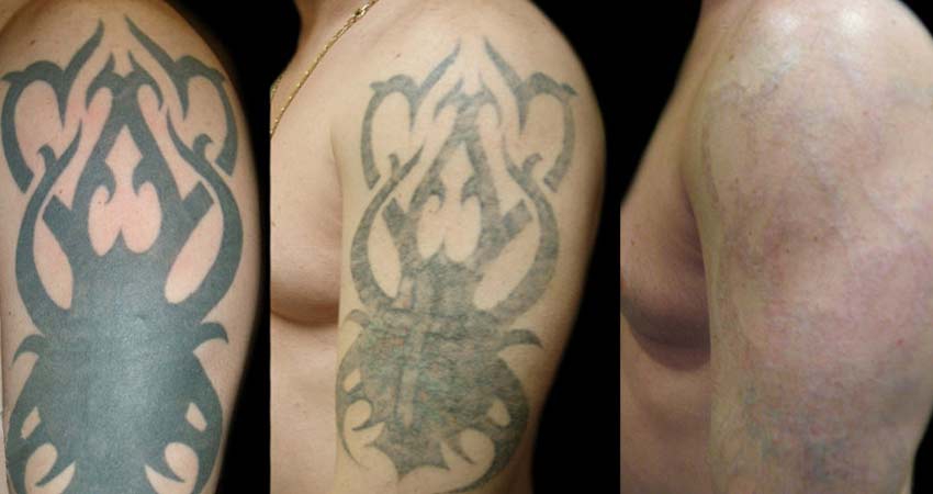 پاک کردن خالکوبی با لیزر بهتر است یا ریموور؟