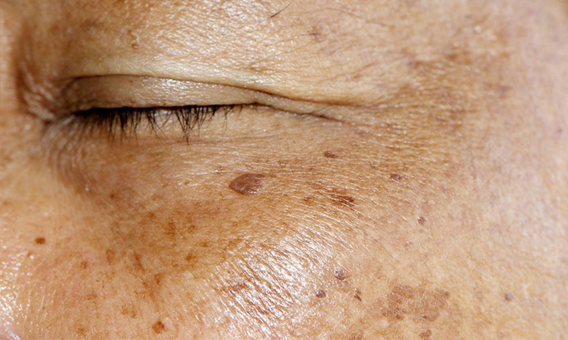 هیپر پیگمانتاسیون