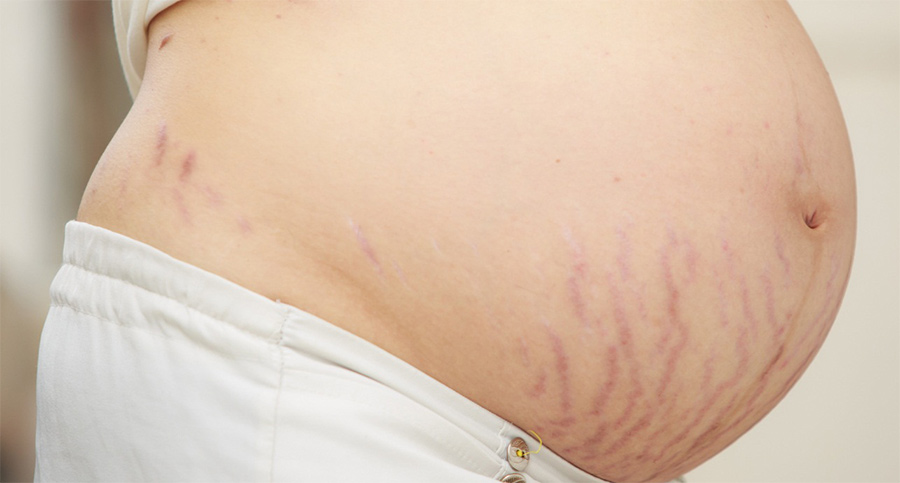 ترک های پوستی