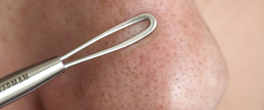 لیزر منافذ پوستی