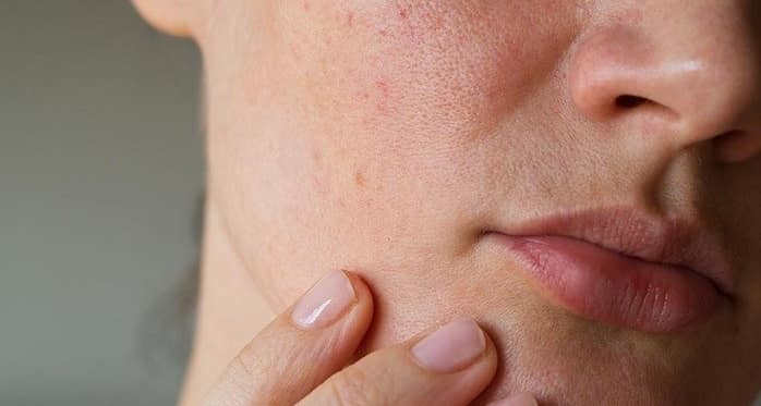 پوست پرتقالی