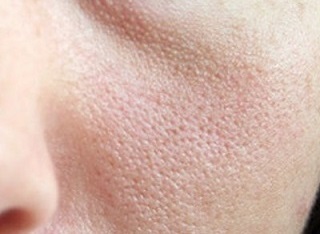 پوست پرتقالی