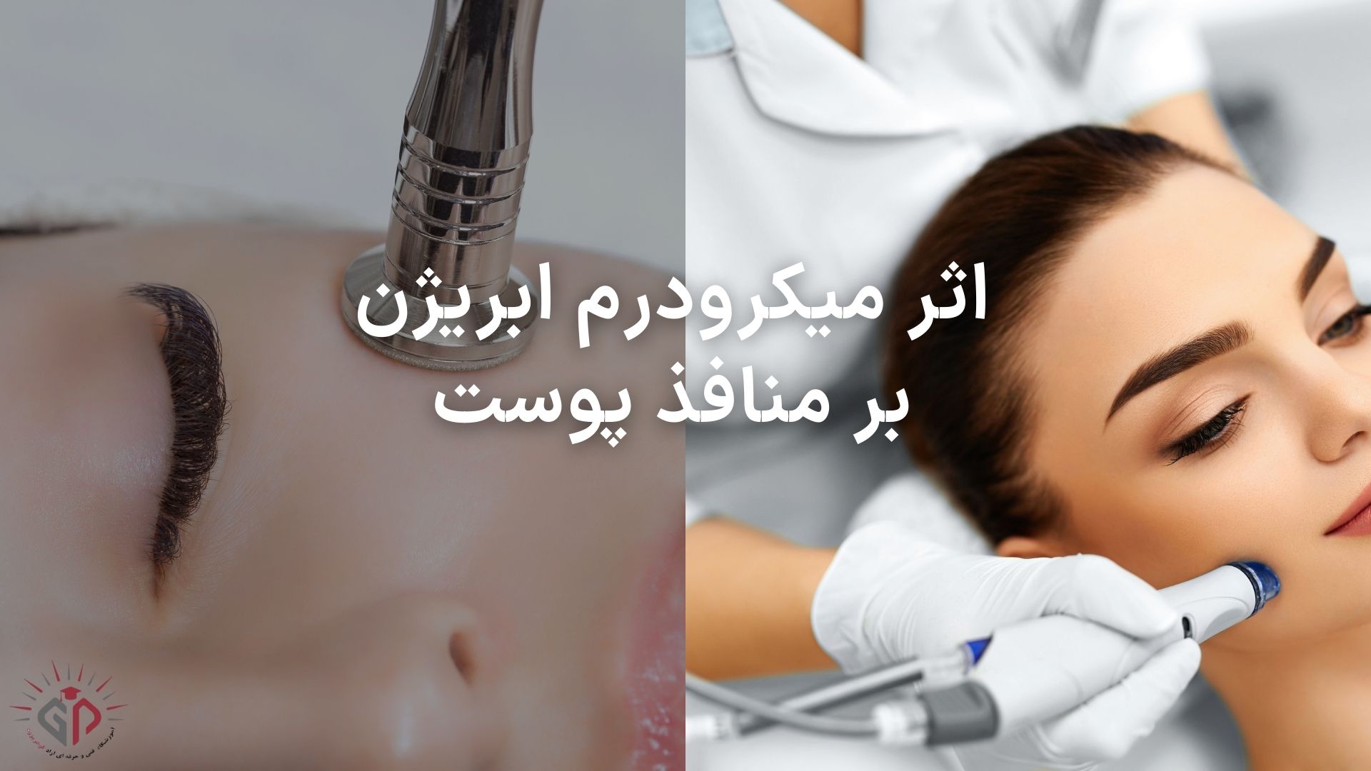 اثر میکرودرم ابریژن بر منافذ پوست