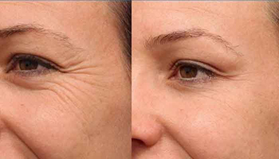 راه های پیشگیری از چین و چروک دور چشم