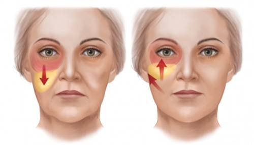 فرم دهی گونه