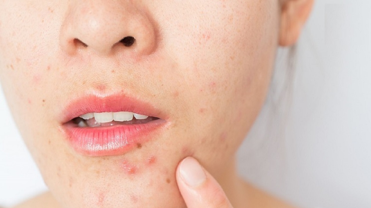 باورهای غلط درباره ی آکنه