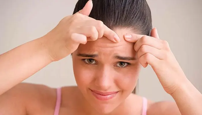 درمان آکنه با مراقبت خانگی