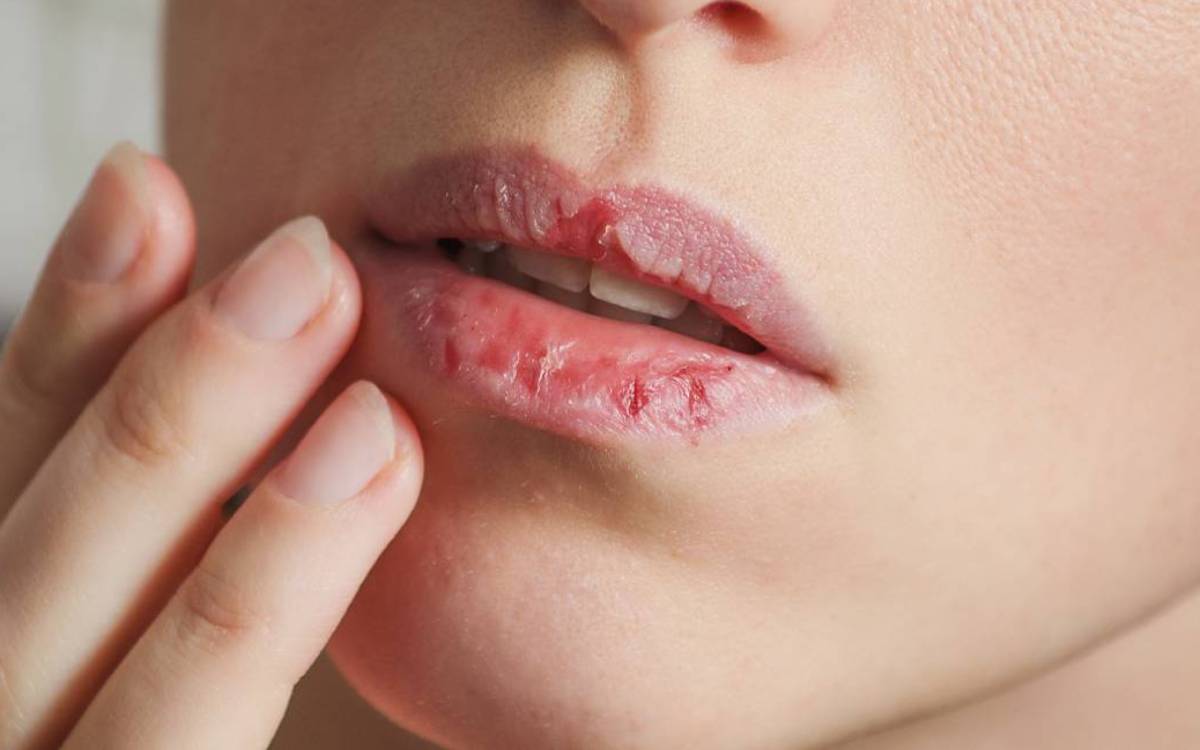 درمان خشکی لب