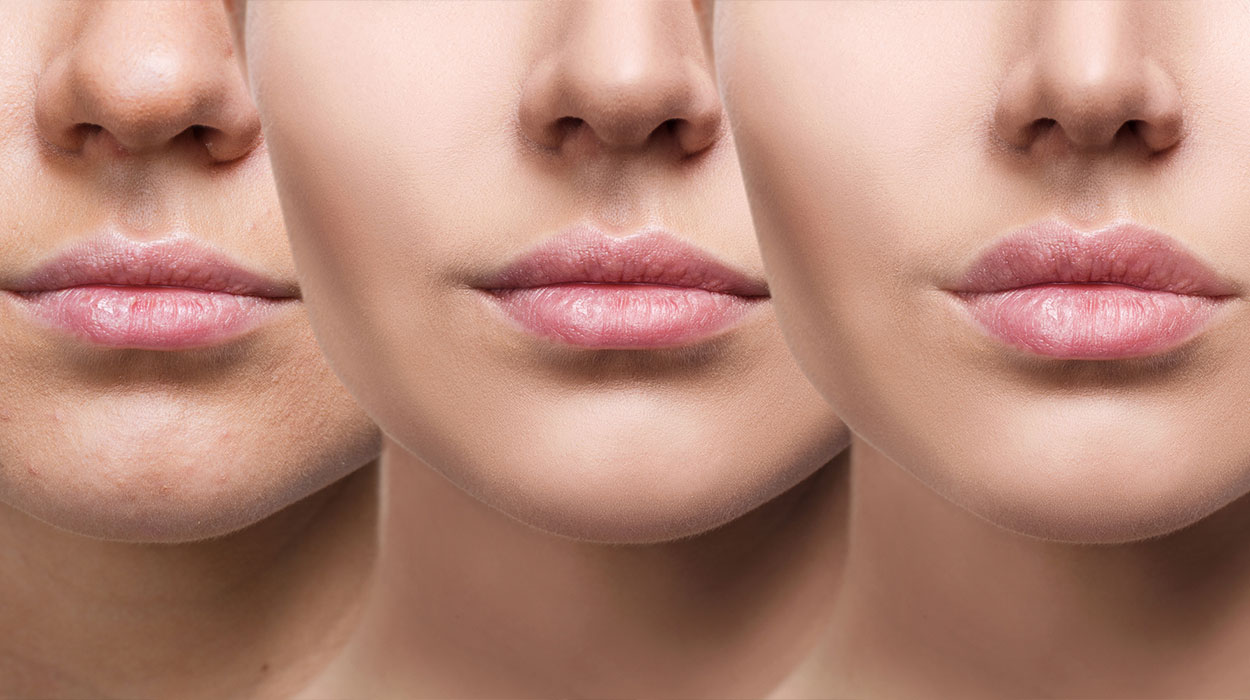 مادلینگ صورت چیست؟