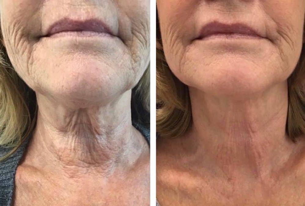 دستگاه هایفو خانگی