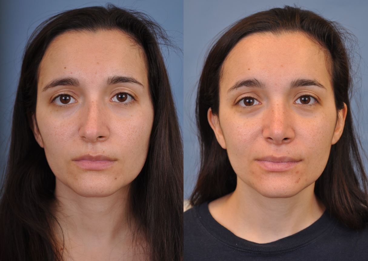 عمل سپتوپلاستی چیست؟