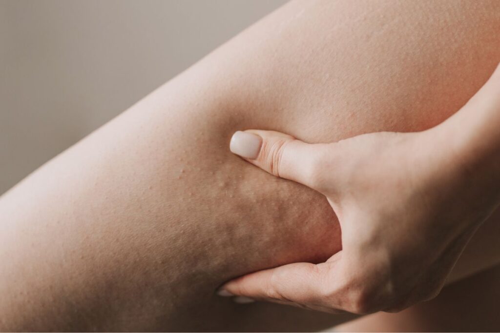 چگونه ماساژ میتواند به کاهش سلولیت کمک کند؟